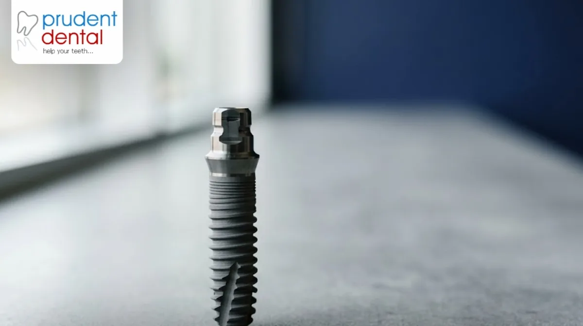 Are dental implants worth it? Lifespan, care and facts
