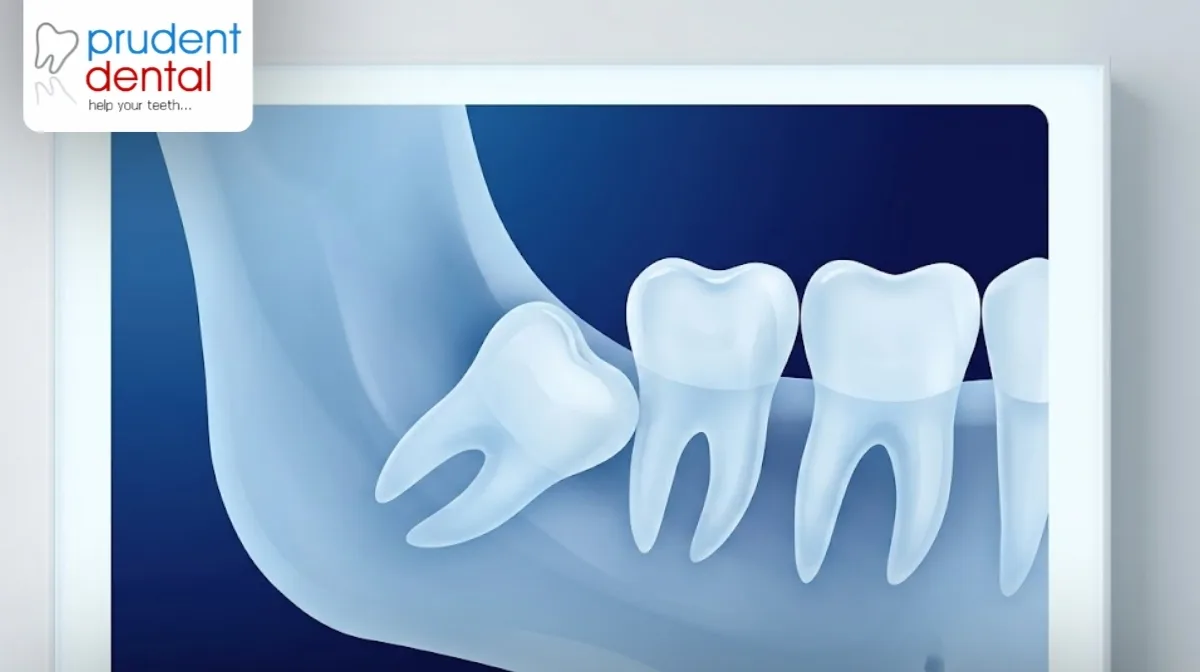 Do wisdom teeth always need to be removed?