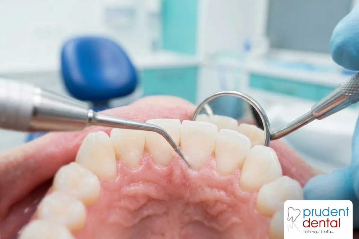 Regular scaling vs deep cleaning: the difference