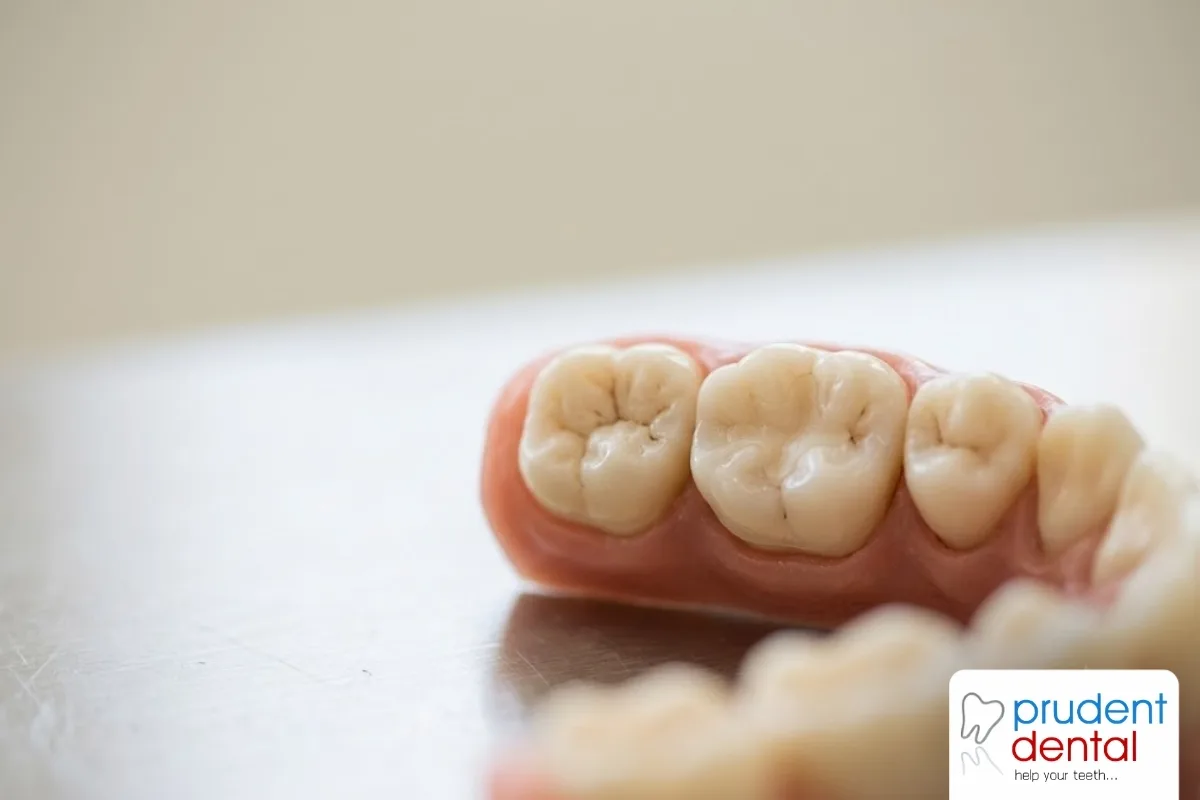 Should you replace old silver fillings with tooth-coloured ones?
