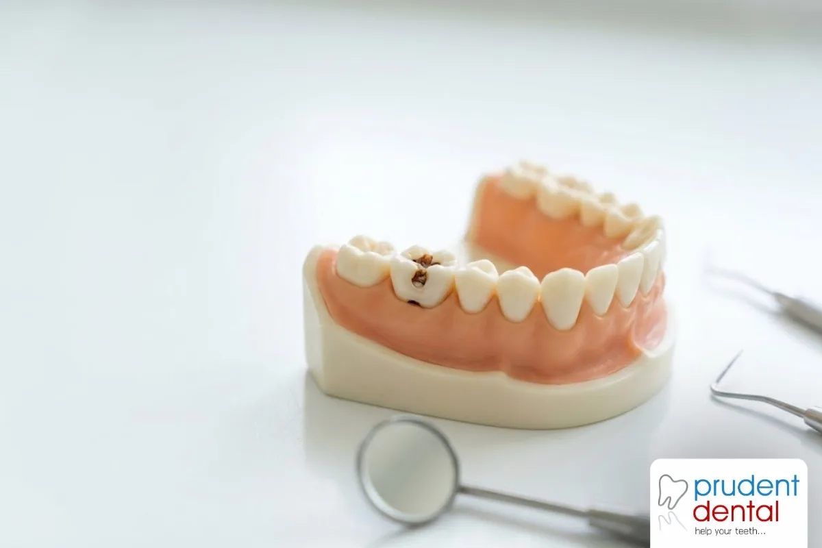 What happens if you do not treat a cavity?