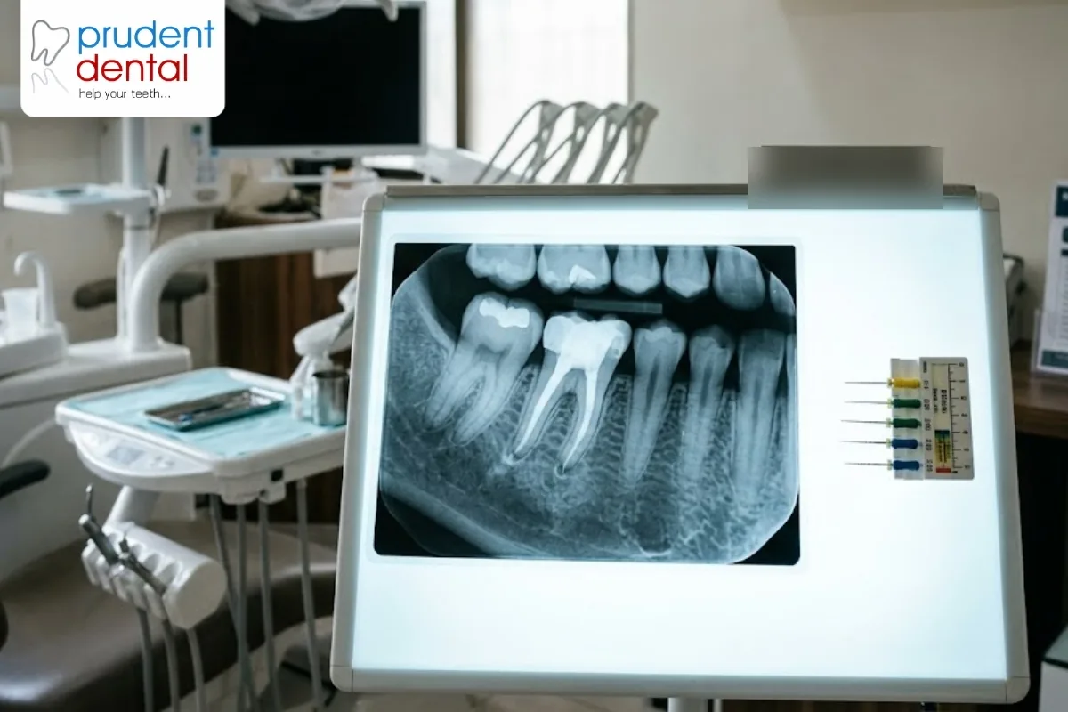 Root canal cost: what you are paying for