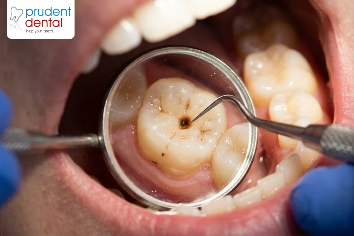 Signs you have a cavity (and what happens next)