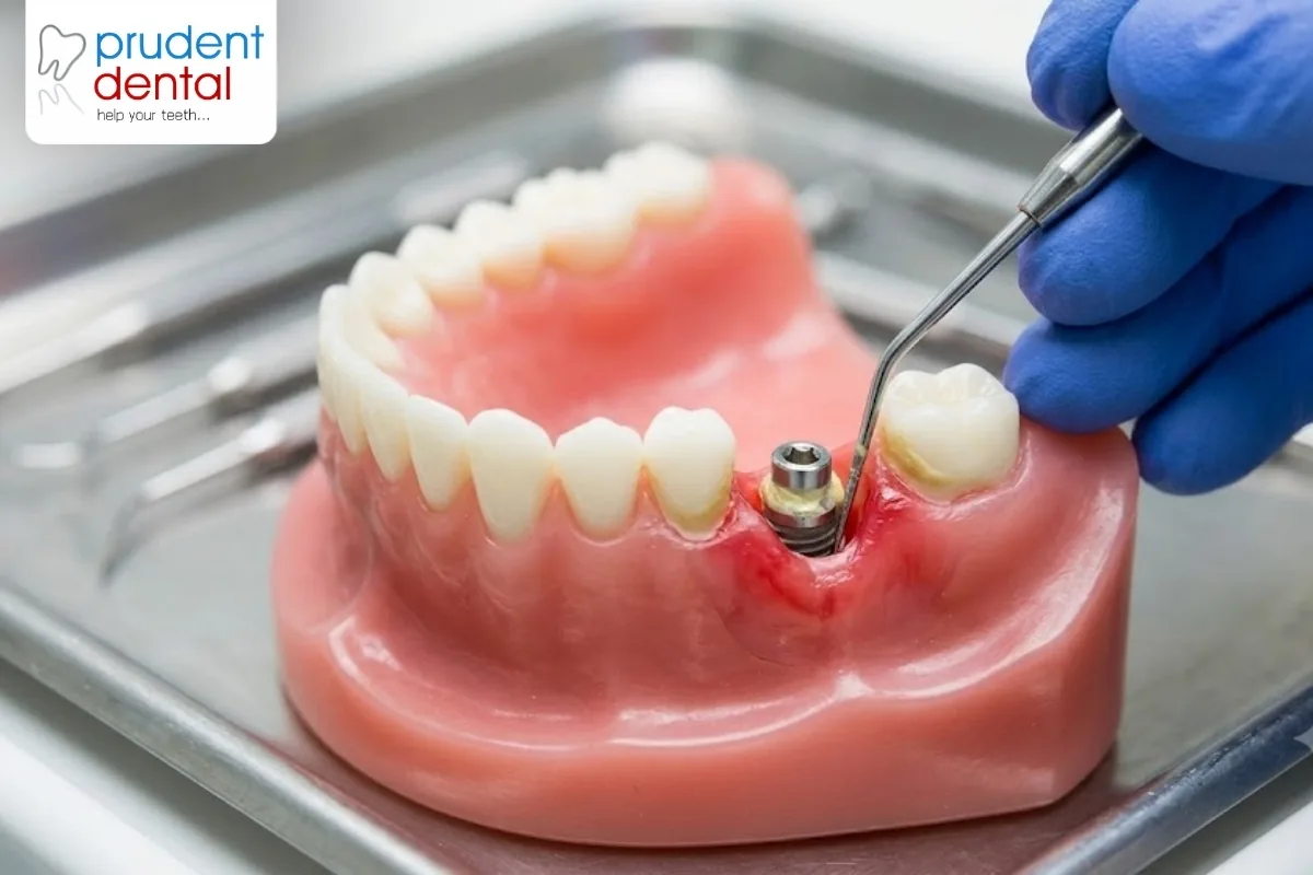 What causes dental implants to fail?