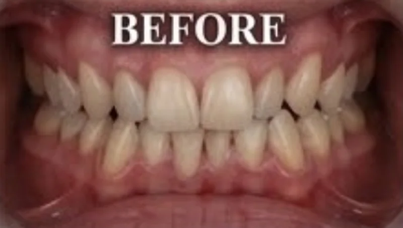 Case 2, Uneven smile evened & brightened, patient's teeth before treatment at Prudent Dental Clinic (published with consent)