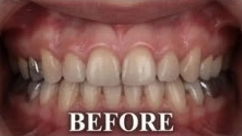 Case 3, Discoloured back teeth restored, patient's teeth before treatment at Prudent Dental Clinic (published with consent)