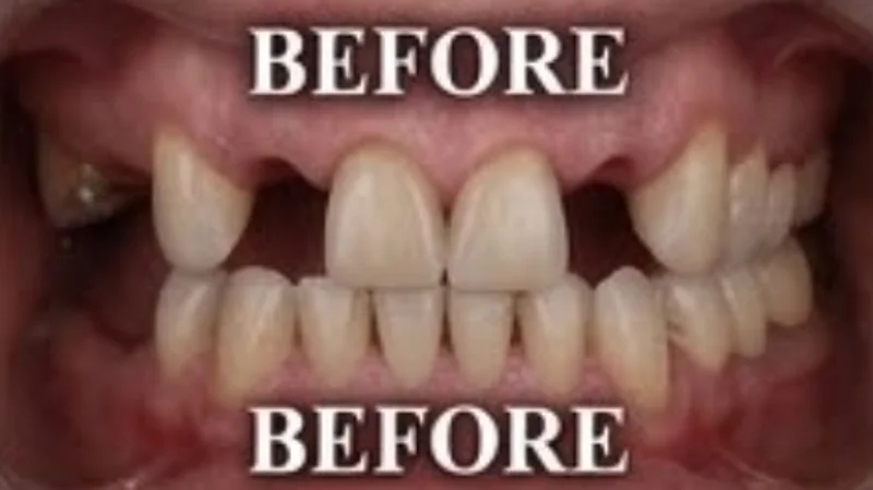 Case 4, Missing front teeth replaced, patient's teeth before treatment at Prudent Dental Clinic (published with consent)