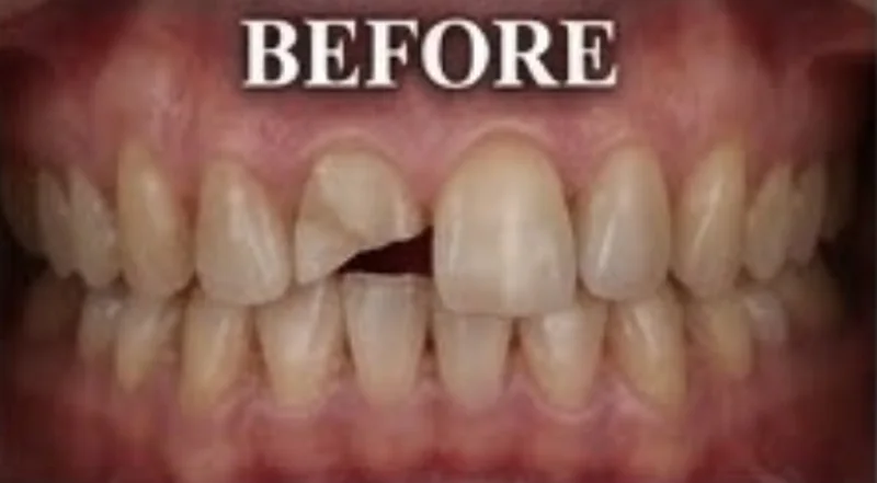 Case 6, Broken front tooth rebuilt, patient's teeth before treatment at Prudent Dental Clinic (published with consent)