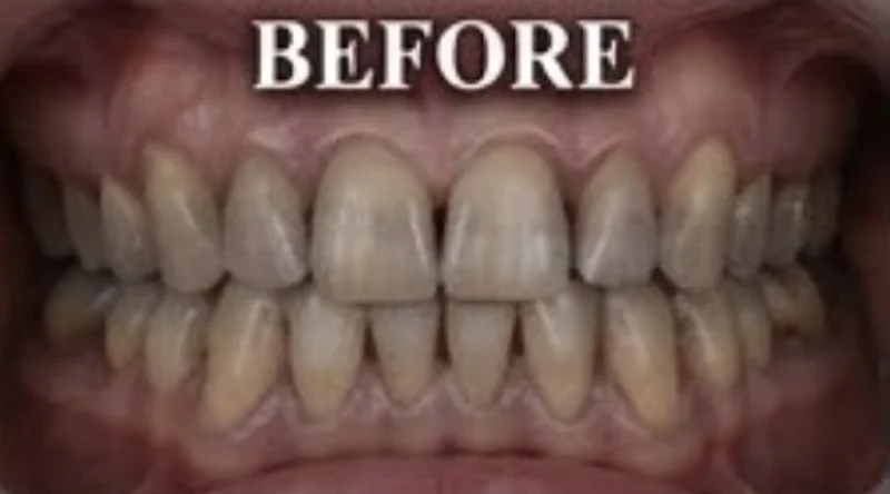 Case 7, Deep stains removed, patient's teeth before treatment at Prudent Dental Clinic (published with consent)
