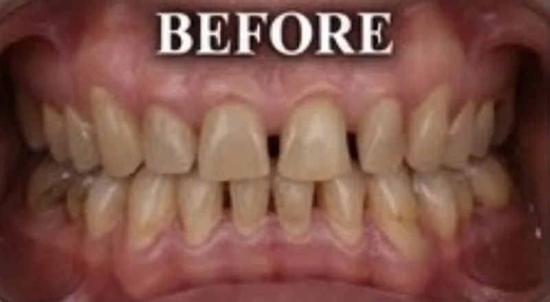 Case 8, Stains & gaps corrected, patient's teeth before treatment at Prudent Dental Clinic (published with consent)