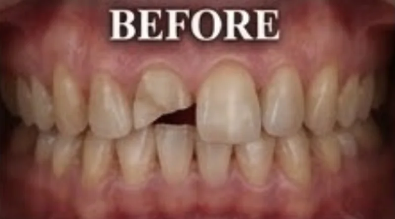 Case 9, Chipped tooth & gap restored, patient's teeth before treatment at Prudent Dental Clinic (published with consent)