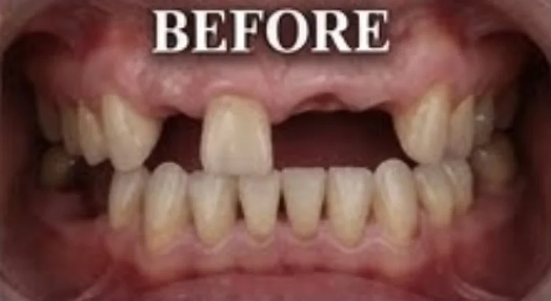 Case 10, Full upper arch restored, patient's teeth before treatment at Prudent Dental Clinic (published with consent)