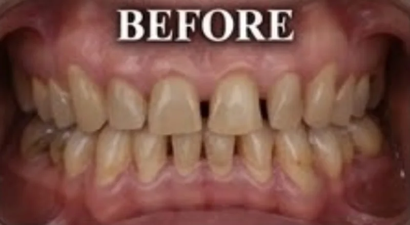Case 11, Spacing & shade corrected, patient's teeth before treatment at Prudent Dental Clinic (published with consent)