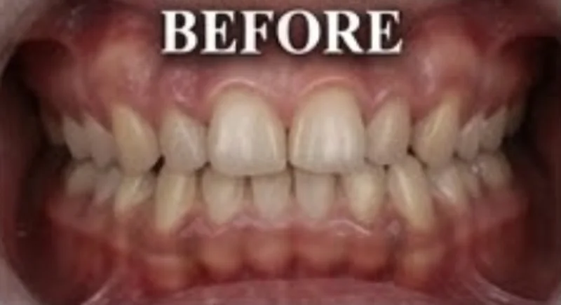 Case 12, Worn smile rejuvenated, patient's teeth before treatment at Prudent Dental Clinic (published with consent)