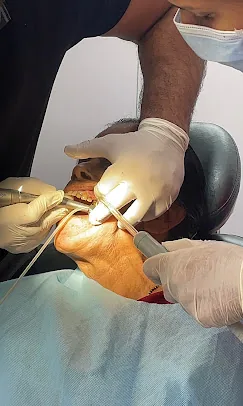 Close-up of a dental implant procedure at Prudent Dental Clinic, Viman Nagar